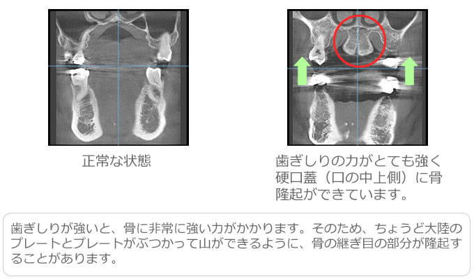 骨隆起が硬口蓋（口の中上側）にできた例