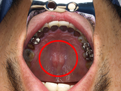 骨隆起が硬口蓋（口の中上側）にできた例